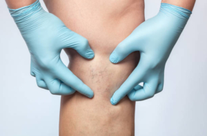 dokter trombose spatader
