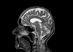 MRI CT SCAN HOOFD HERSENEN SINUS beroerte