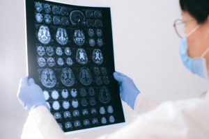 hersenen infarct herseninfarct ct mri