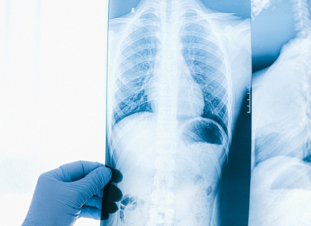 Wat is een longinfarct trombosestichting
